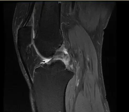 【有声病例】后交叉韧带断裂