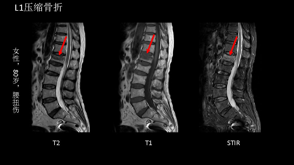朗润15t磁共振临床应用脊柱