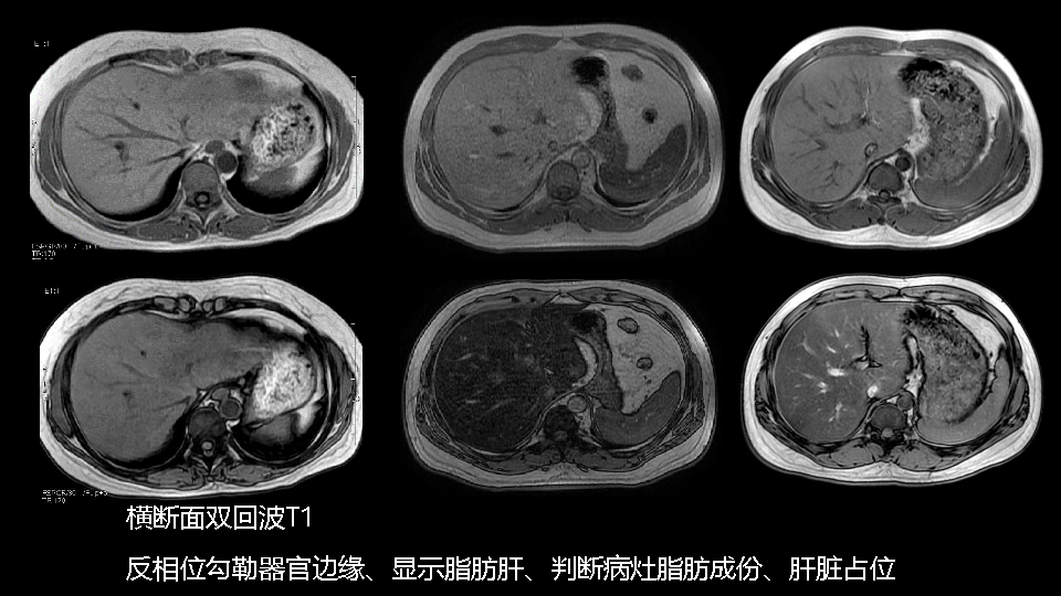 朗润15t磁共振临床应用腹部