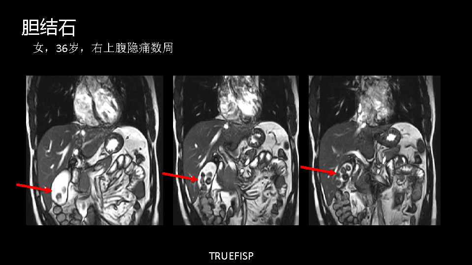 朗润15t磁共振临床应用腹部