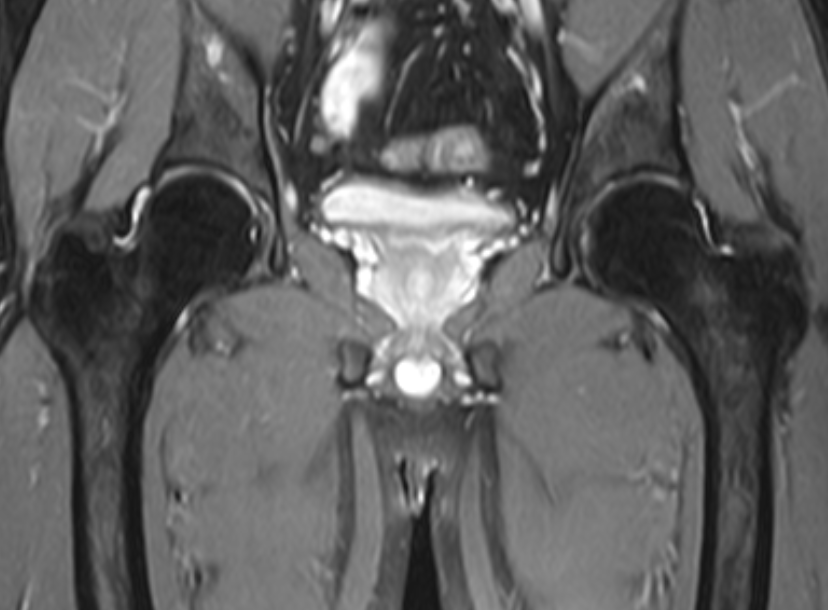 髋关节-fs T2