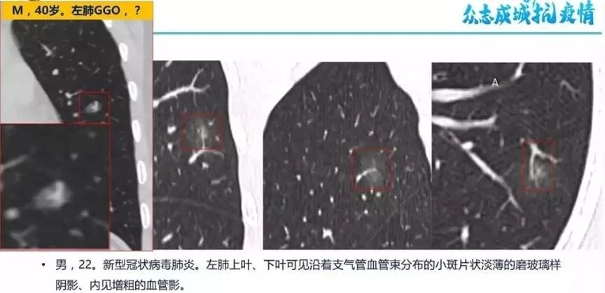 朗润战疫|CT影像学识别与诊断